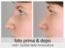 rinoplastica-pre-post